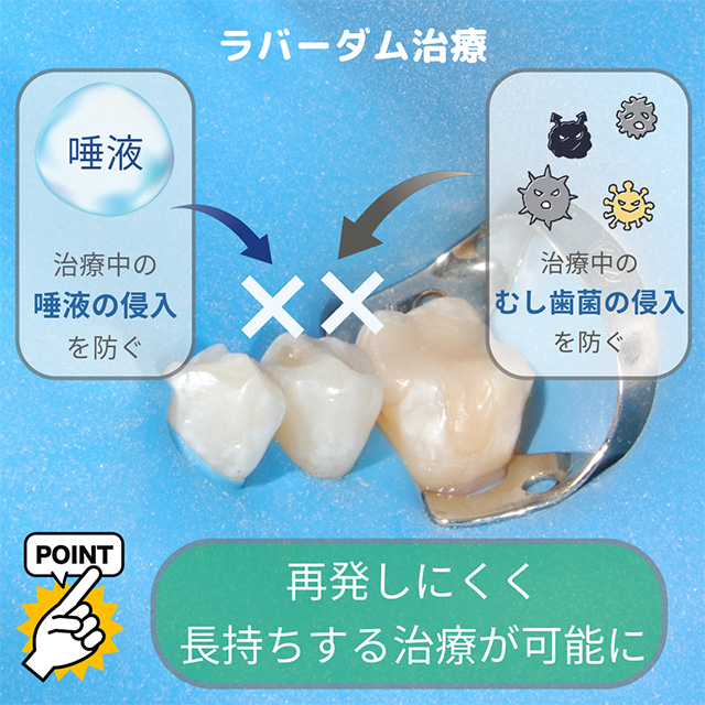 ラバーダムで唾液の侵入を防ぐ仕組み
