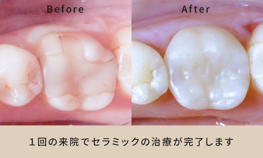 デジタルセラミックBefore After