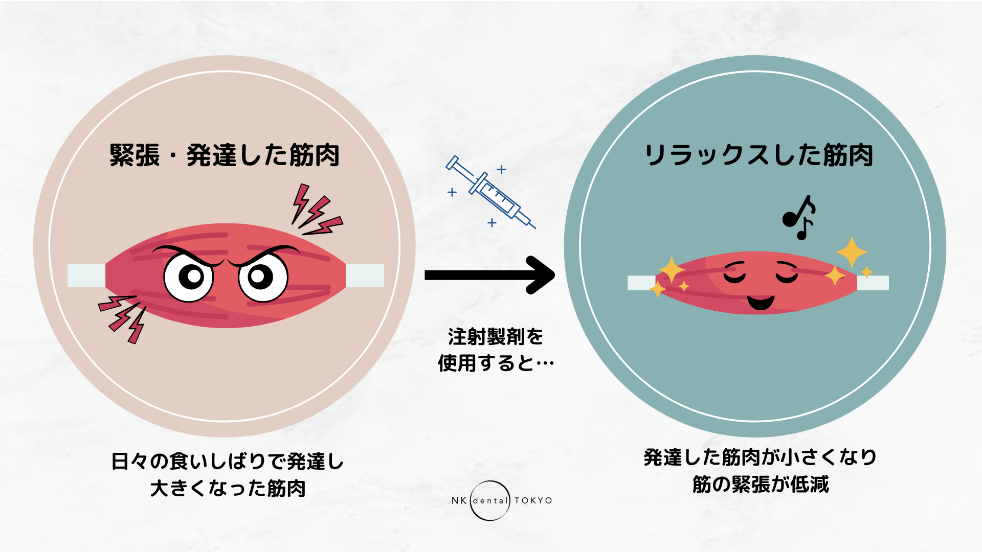 咬筋・側頭筋注射は食いしばりへの効果