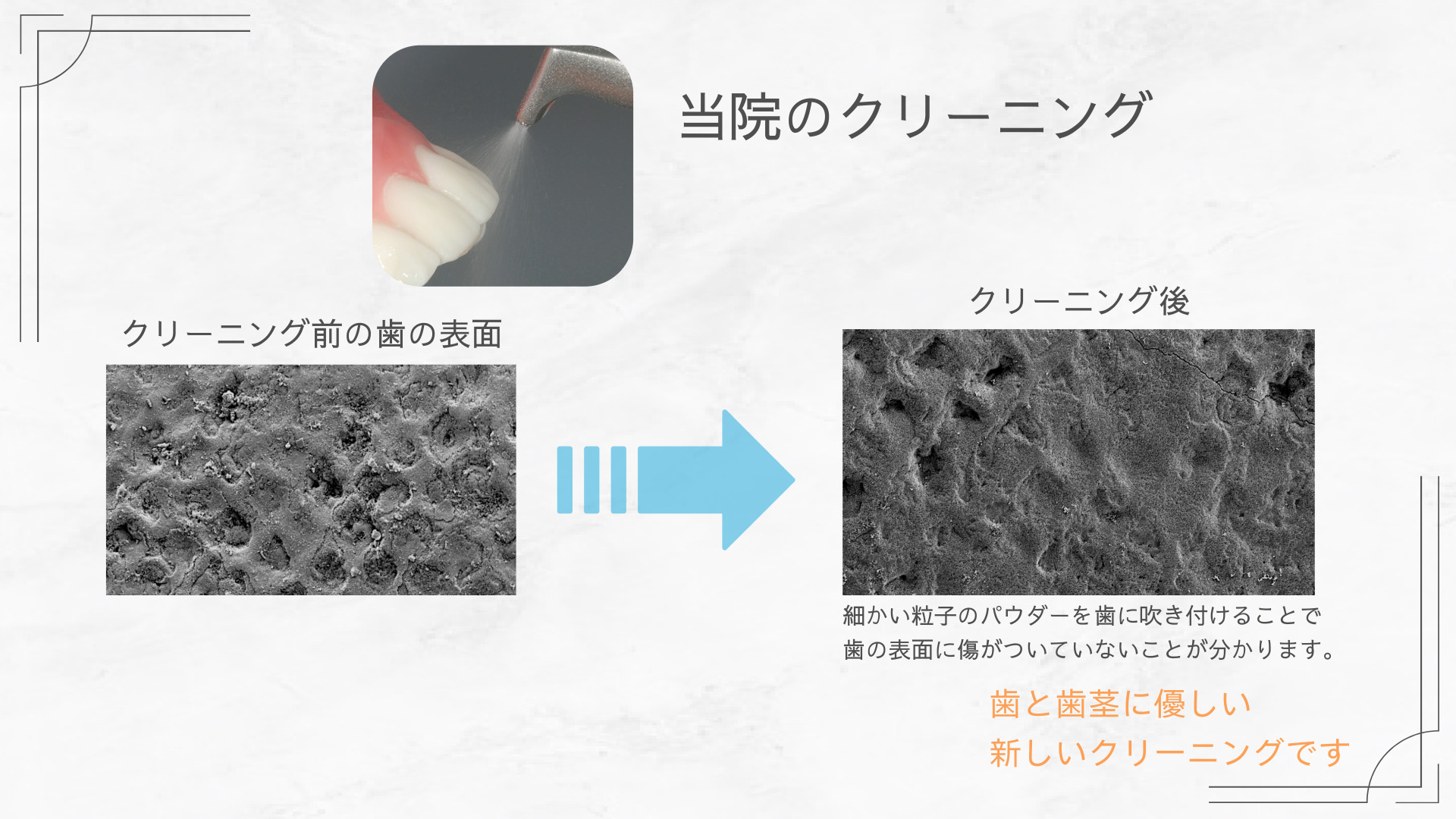 クリーニング前後比較 当院のクリーニング