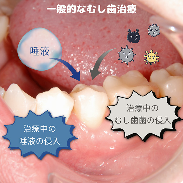 ラバーダムなし